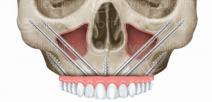 Sorriso dopo i 70 anni: ecco come